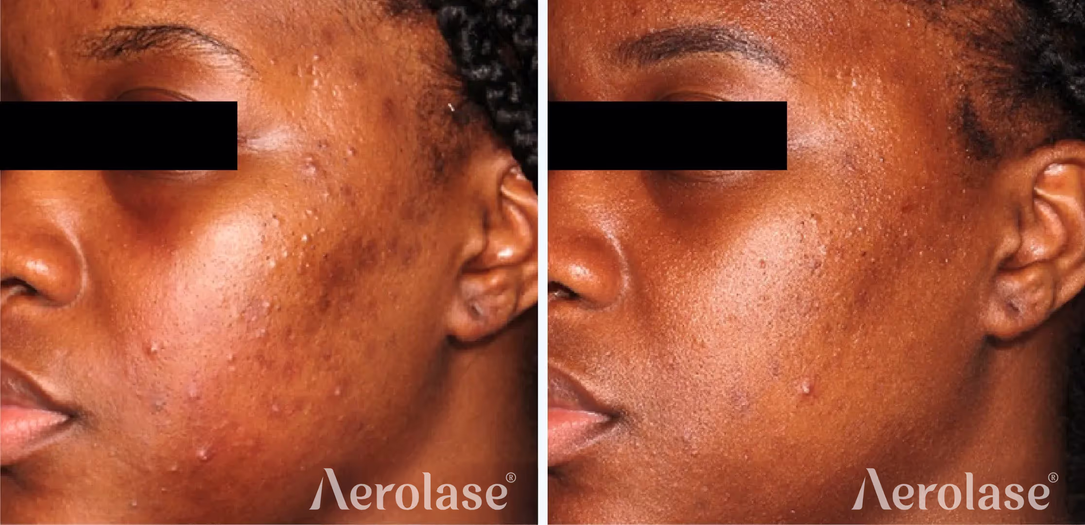 Aerolase Neo Elite — Acne before and after, courtesy of Michelle Henry, MD