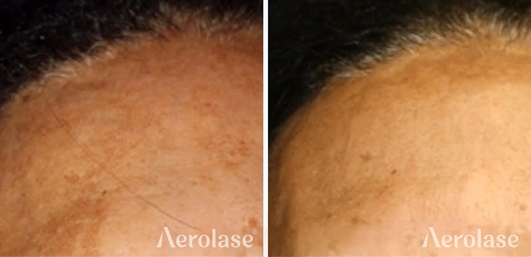 Aerolase Neo Elite — Melasma before and after, courtesy of Cheryl Burgess, MD
