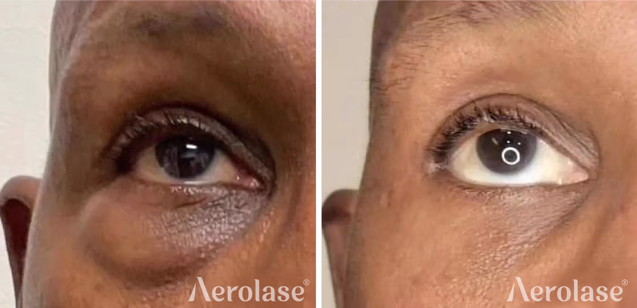 Aerolase Neo Elite — Sun damage & pigmentation before and after, courtesy of Camille Cash, MD