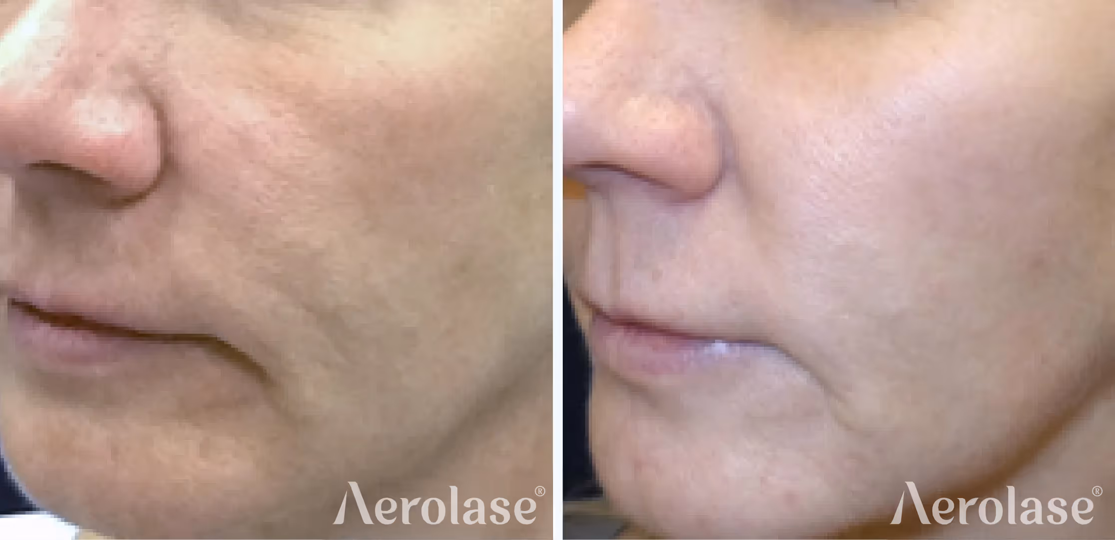 Aerolase Neo Elite — Skin rejuvenation before and after, courtesy of Kevin Pinski, MD