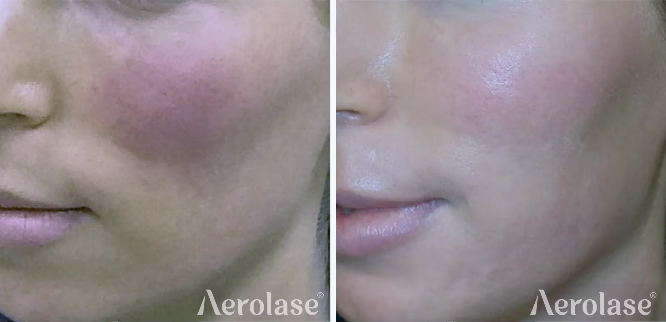 Aerolase Neo Elite — Redness & Rosacea before and after, courtesy of Kevin Pinski, MD