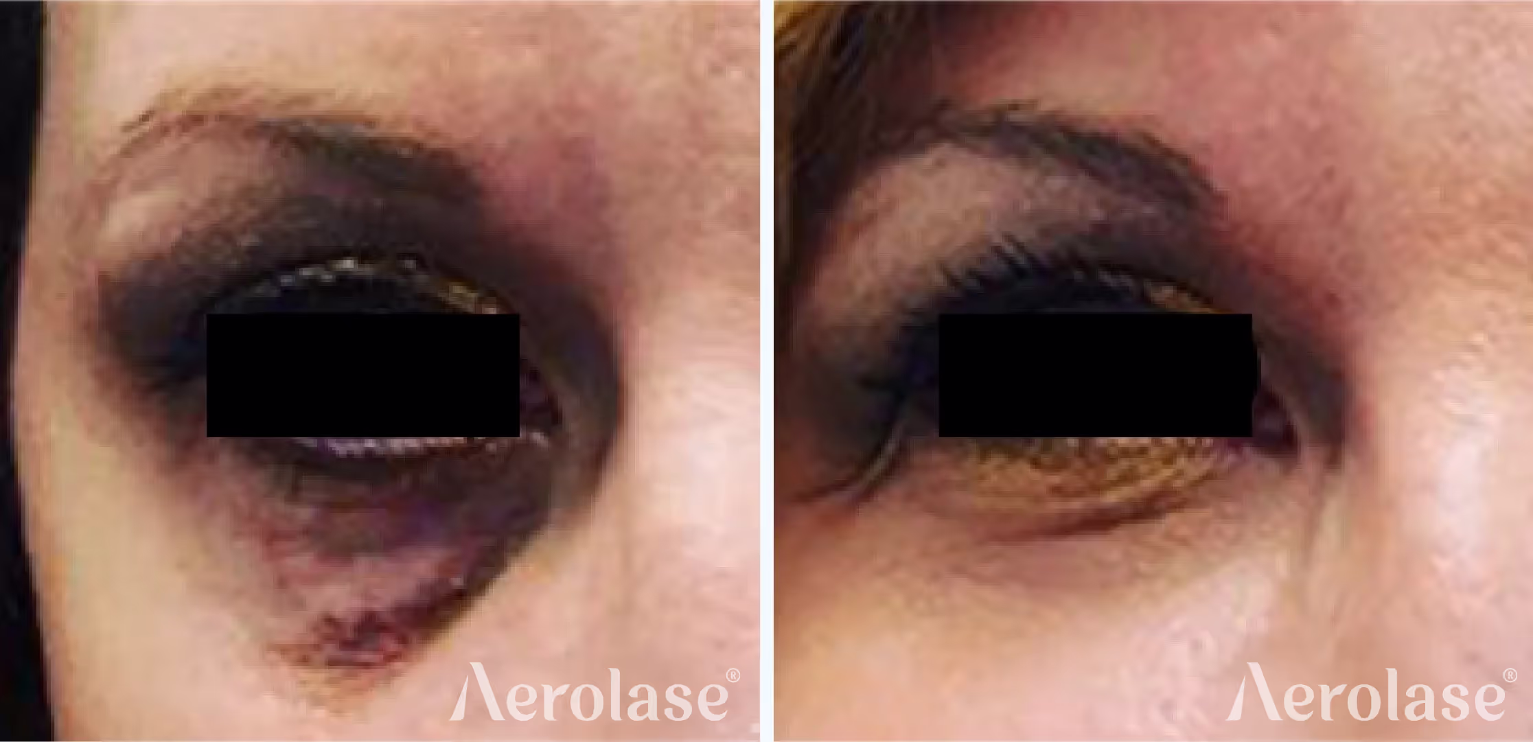 Aerolase Neo Elite — Facial veins before and after, courtesy of Jason Emer, MD