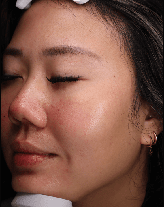 Elizabeth — after, Pigmentation & tightening