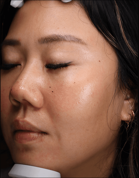 Elizabeth — before, Pigmentation & tightening