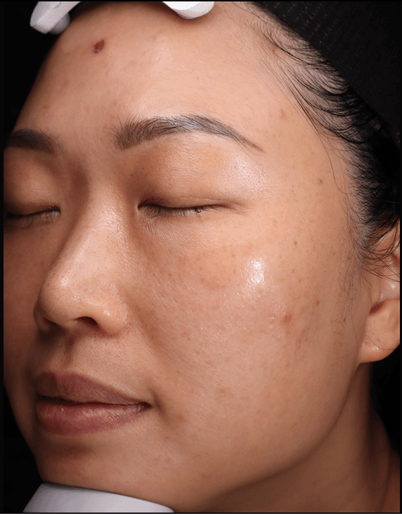 Serene, after, Cheek laxity & redness