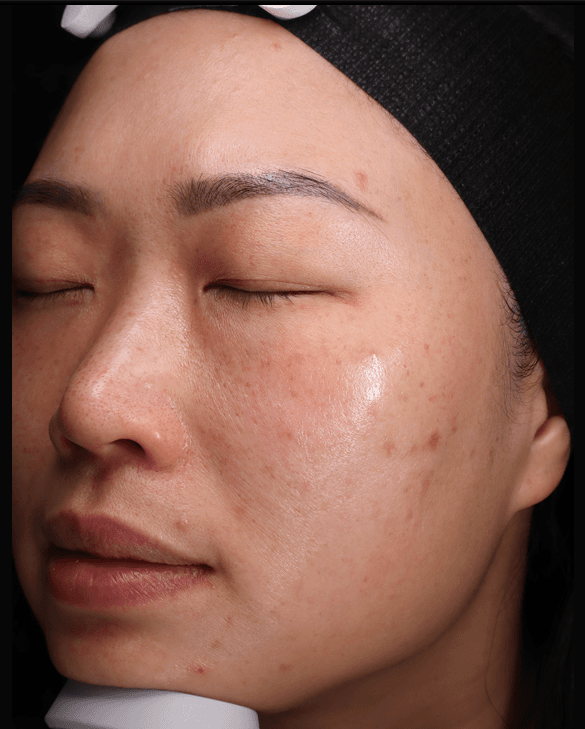 Serene, before, Cheek laxity & redness