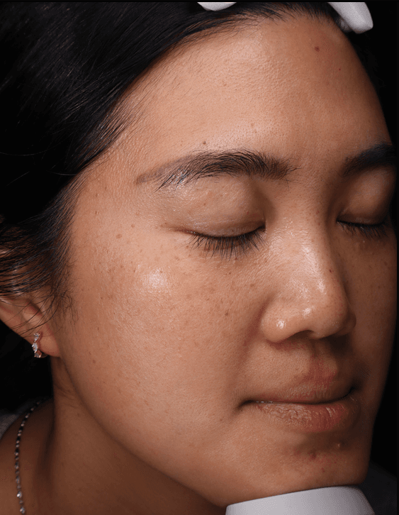 Tee, after, Pigmentation & dullness