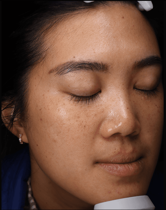 Tee, before, Pigmentation & dullness