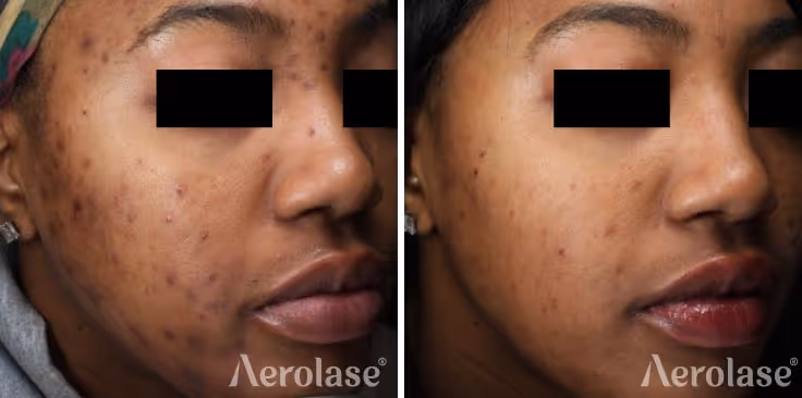 Aerolase Neo Elite, Acne & pigmentation before and after