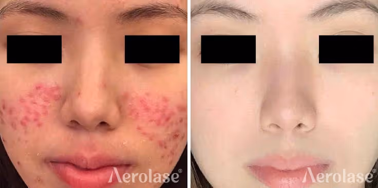 Aerolase Neo Elite, Acne before and after