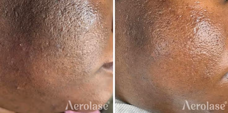 Aerolase Neo Elite, Sun damage & pigmentation before and after