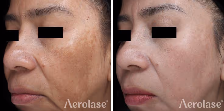 Aerolase Neo Elite, Melasma before and after