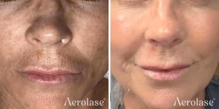Aerolase Neo Elite, Skin rejuvenation before and after