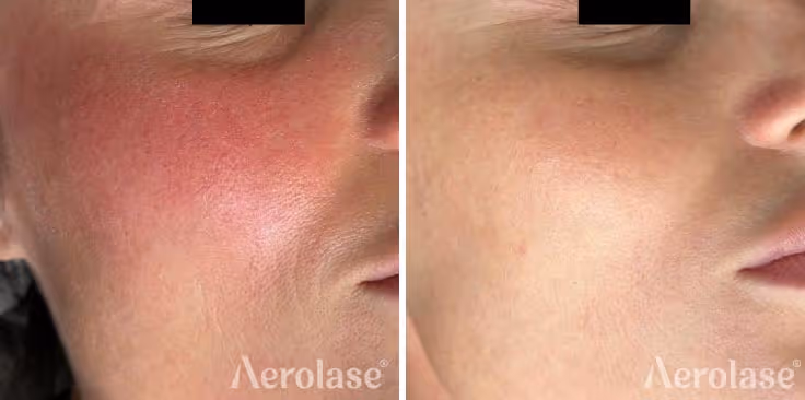 Aerolase Neo Elite, Redness & Rosacea before and after