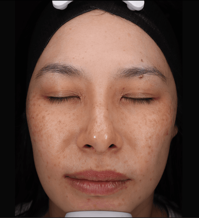 Fiona, after treatment at PM Aesthetics
