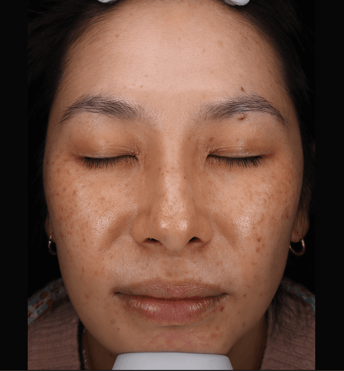 Fiona, before treatment at PM Aesthetics