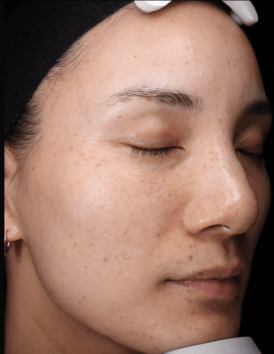 Mel, after treatment at PM Aesthetics