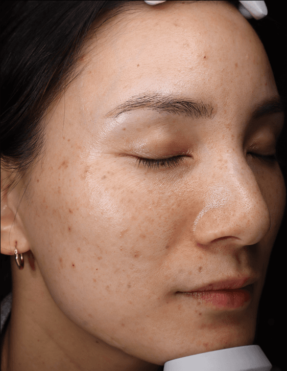 Mel, before treatment at PM Aesthetics