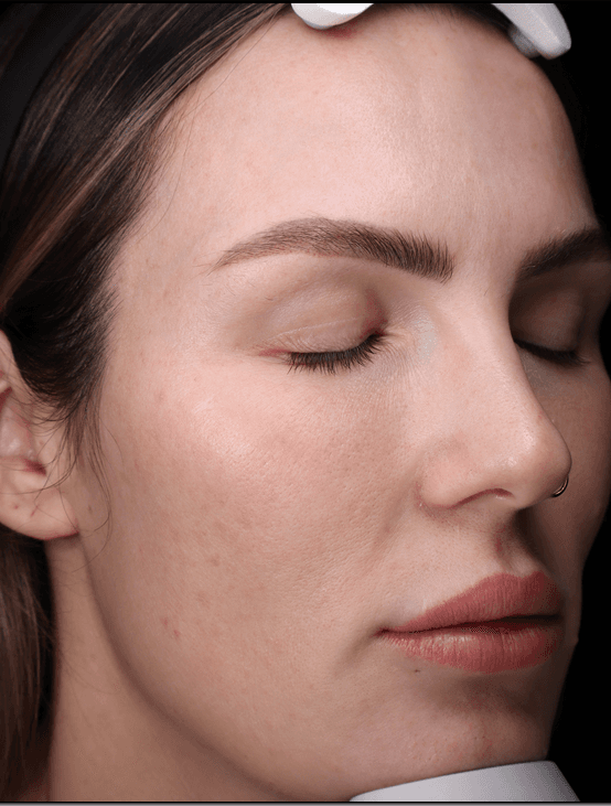 Tiegen, after treatment at PM Aesthetics