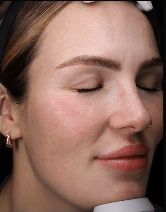 Tiegen, before treatment at PM Aesthetics