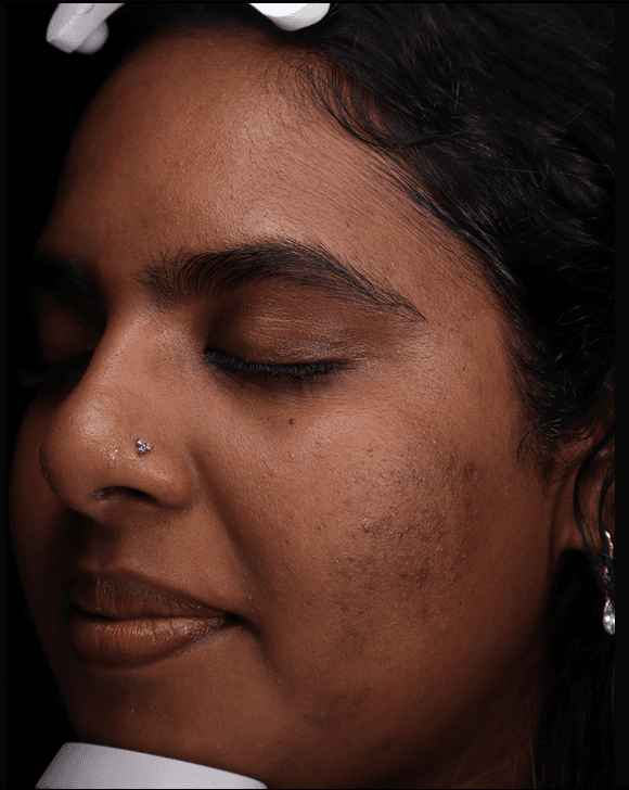 Vino, after treatment at PM Aesthetics