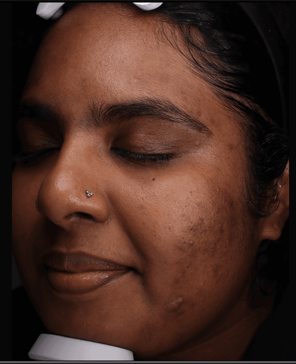 Vino, before treatment at PM Aesthetics